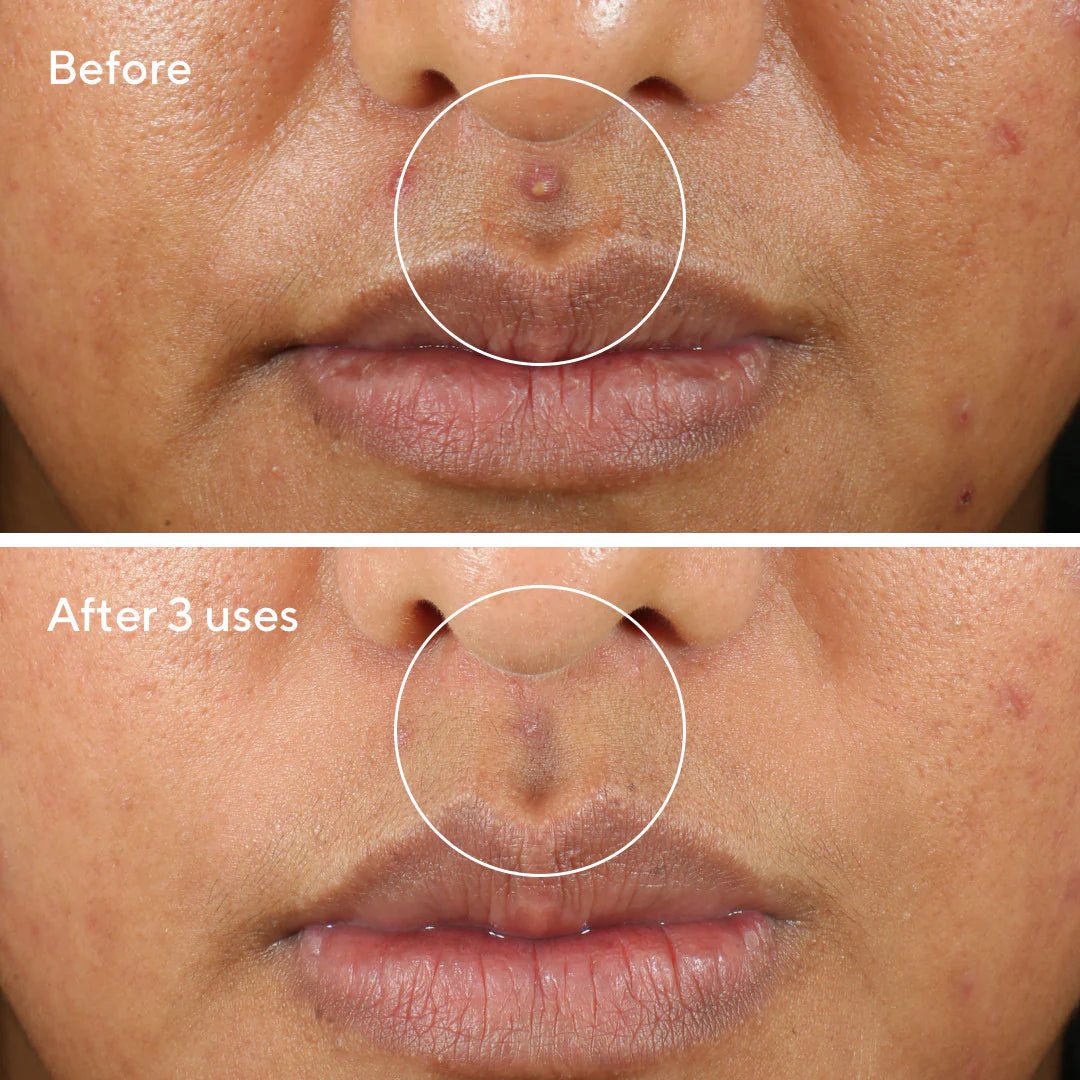 Rapid Relief Sulfur Mask