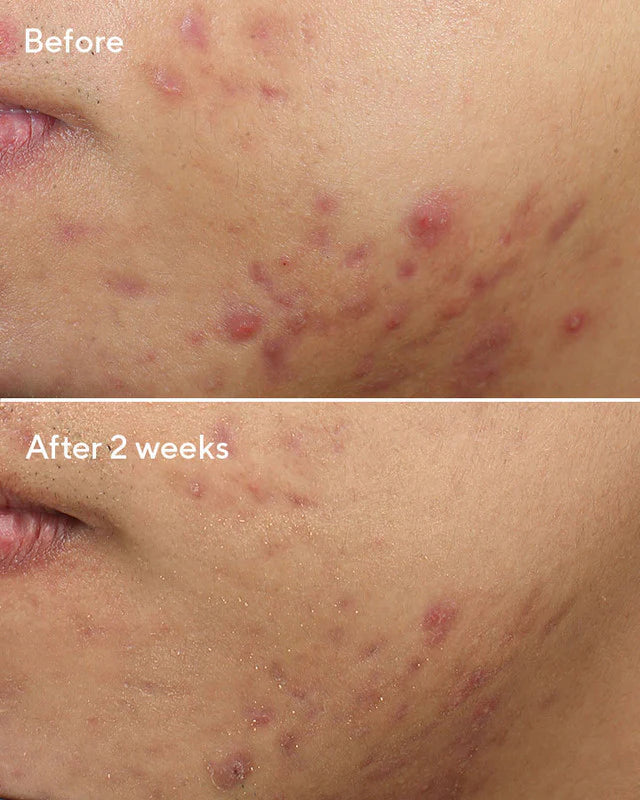 Deep Relief Blemish Treatment 30ml